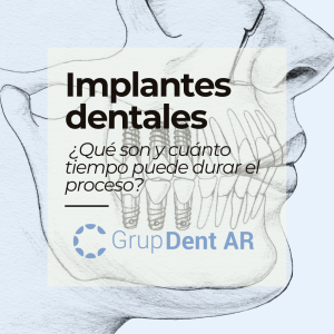 Implantes dentales. ¿Qué son y cuánto tiempo puede durar el proceso
