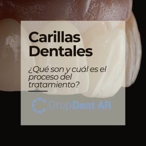 Guía sobre las carillas dentales