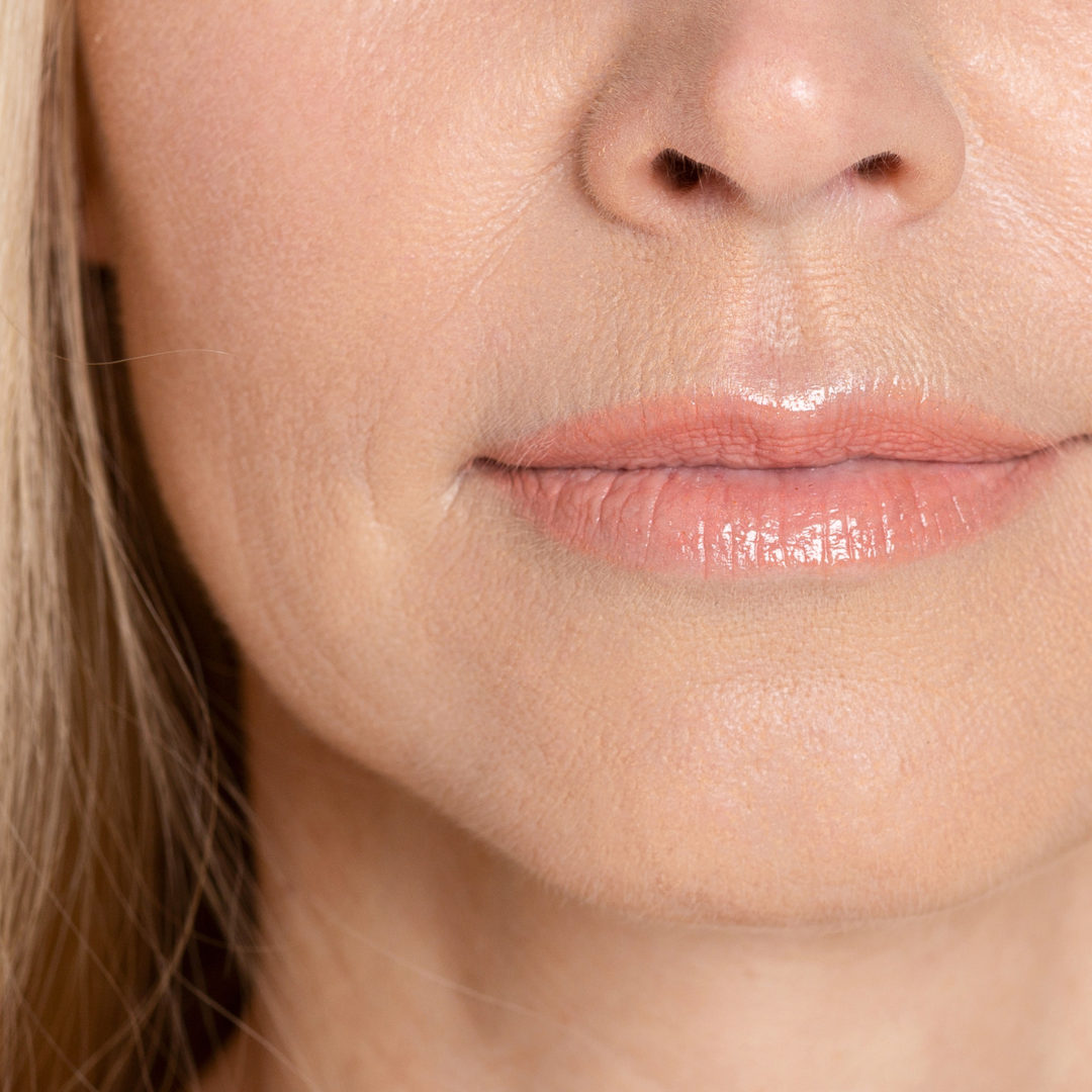 relleno-zona-superior-labios