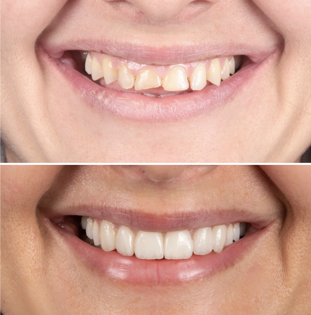 antes y después tratamiento dental en Barcelona