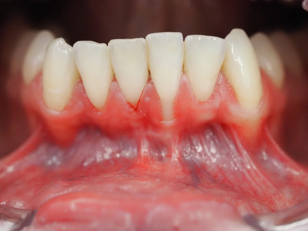Recesión Gingival