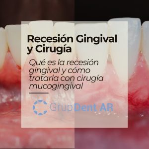 Caso de receisón gingival