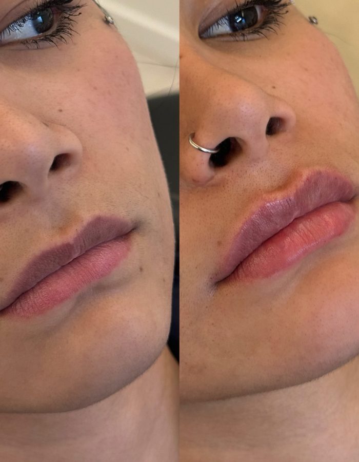 Aumento de Labios