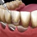 PERIODONCIA