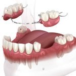 protesis-parcial-q23tnix8hnysj1jlj4e6b8ewyz44p7gqolwf2op9k0